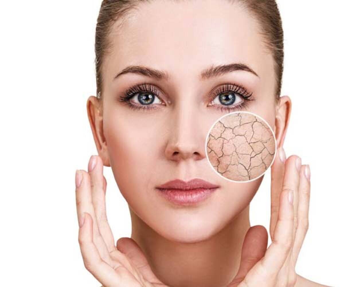 آیا پوست خشکی دارید؟ | با این روش ها به پوست خود طراوت هدیه کنید! | درمان خشکی پوست